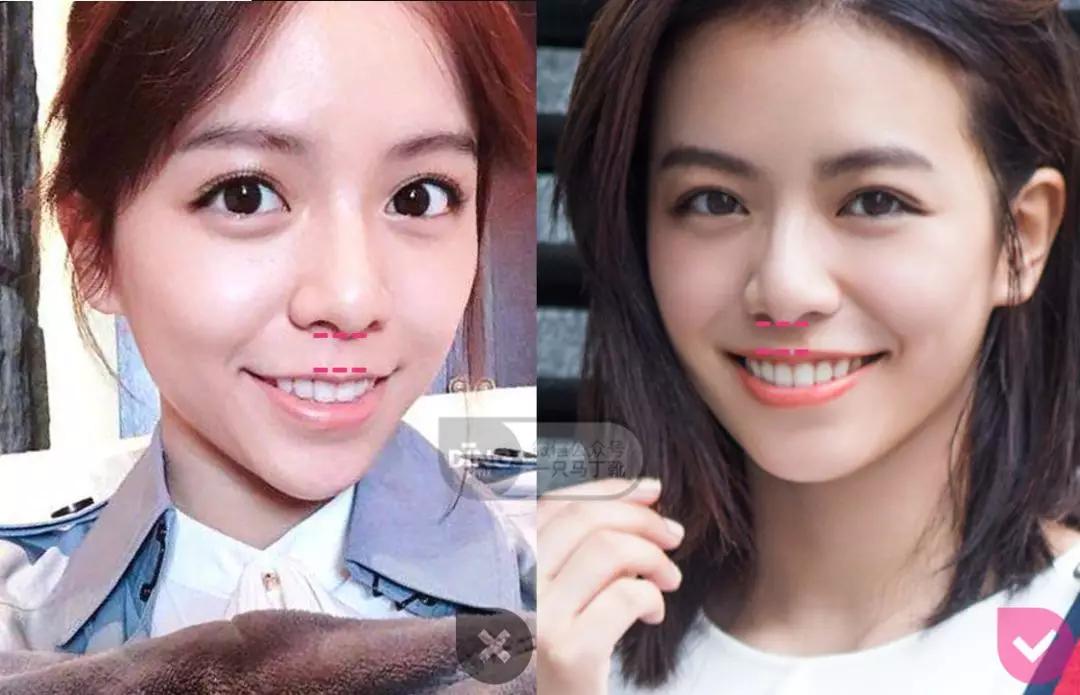 戴牙套凸嘴怎么化妆,凸嘴整牙削骨吗