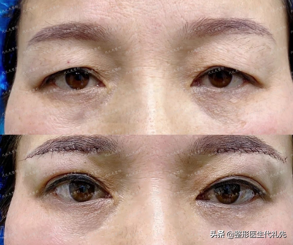 提眉手术半个月了还疼,提眉手术失败了还能修复吗