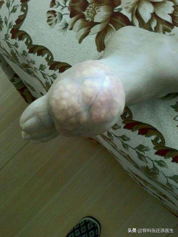 痛风能治愈?尿酸监测,药品选择,除了戒口,我们聊点深入的科普