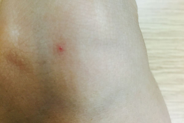 人到中年身上长小红痣是什么原因,身上手上长小红痣不痛不痒