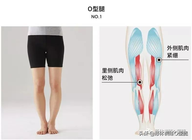 怎样矫正o型腿罗圈腿,o型腿的原因和矫正