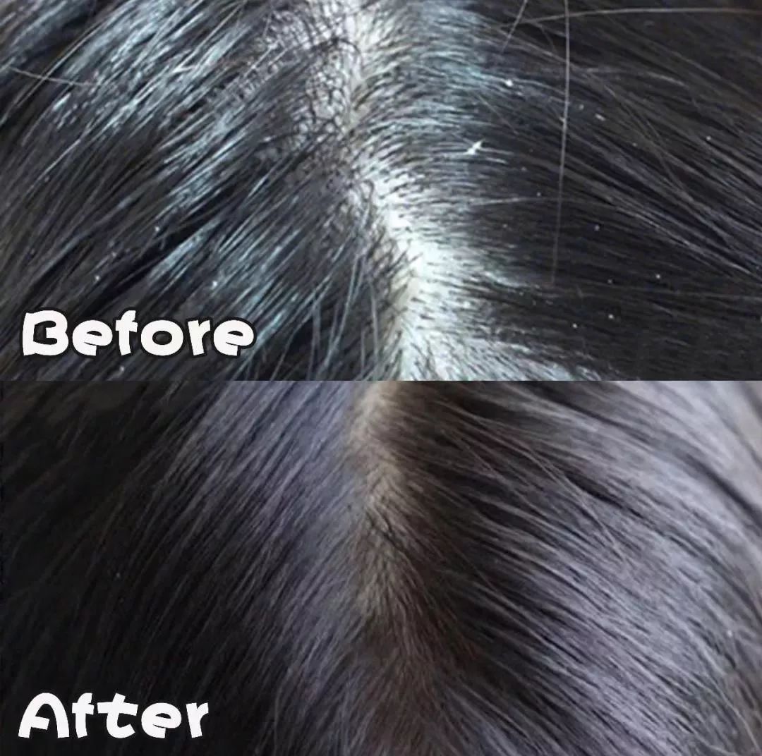 洗发水油头救星去屑止痒,油头救星澳洲茶树洗发水