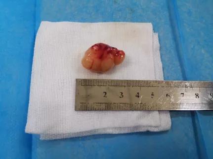 儿童90%为良性,成人却不到10%?患者气短3年,胸部CT提示的气管肿物意味着什么?气管镜有何发现?