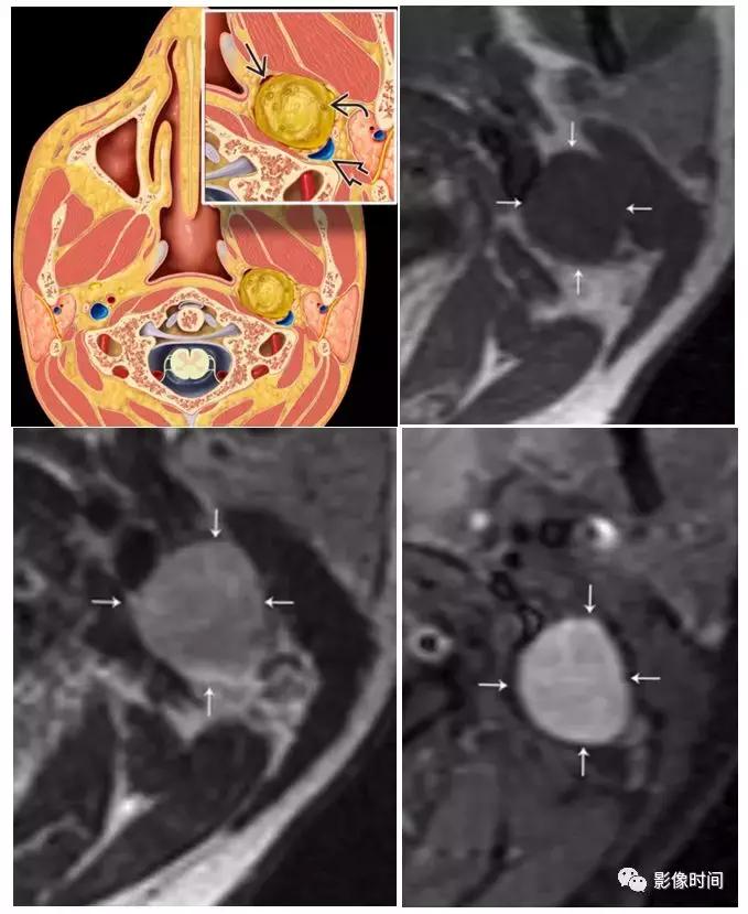 双侧颈动脉鞘间隙多发小淋巴结影,双侧颈动脉间隙多软组织密度结节