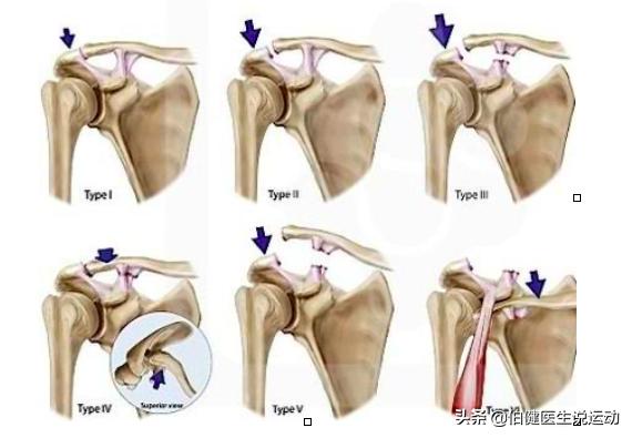胳膊一动关节就咔咔响疼痛,肩关节半脱位抬胳膊嘎嘣响怎么办