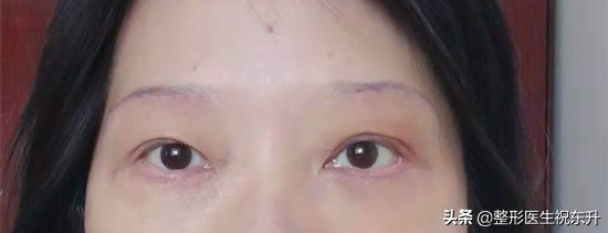 做眼袋提眉法令纹深了,上眼皮的皱纹提眉可以解决吗