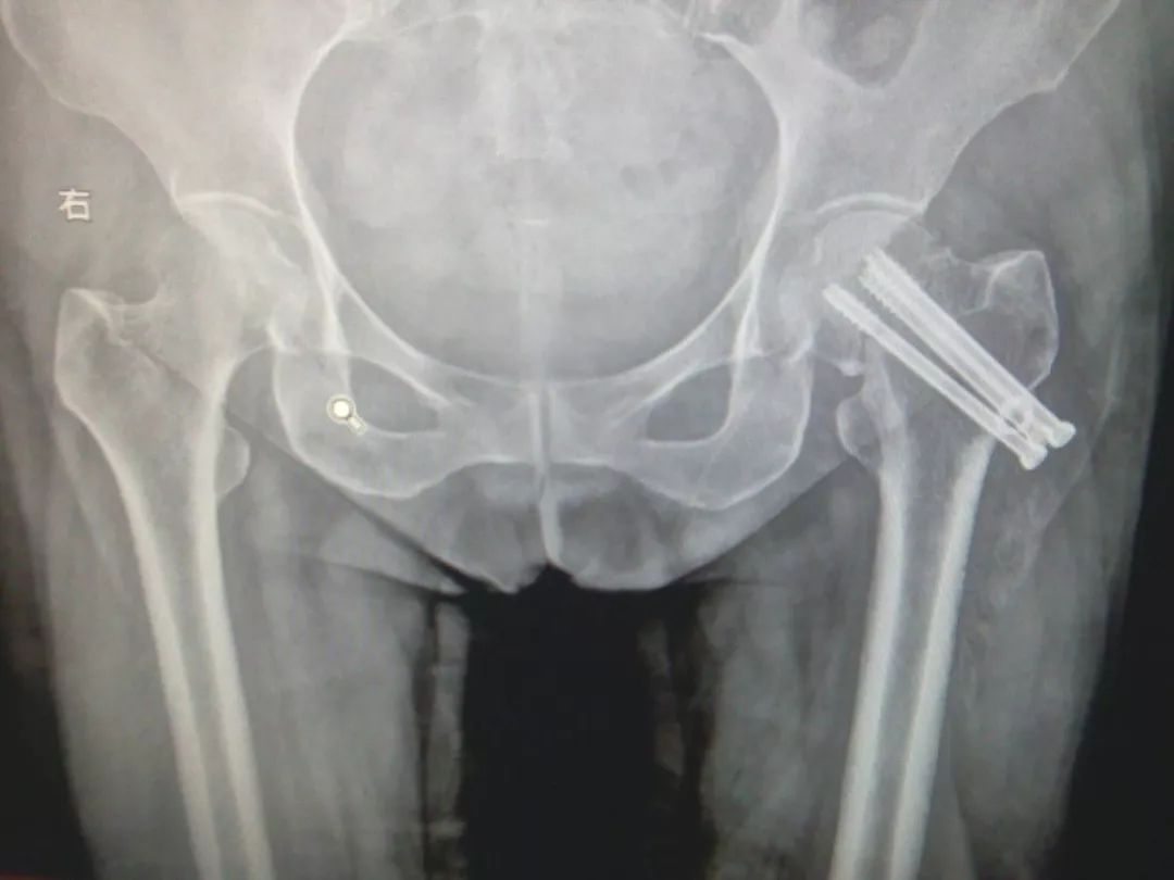 老年髋部骨折最常见的部位,髋部骨折危害大老年人摔伤要重视