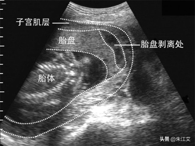 孕期出血怎么办专家教你正确应对,子宫异常出血和功能性出血的区别