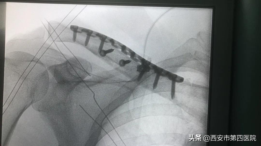 锁骨骨折保守治疗84天,公立医院锁骨骨折手术