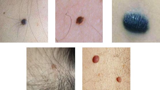 眼睛有泪痣人中有痣是不是不好,泪痣代表什么面部哪些痣必须点掉