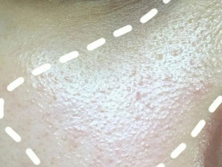 护肤界有名的难缠小妖精，现在搞定它