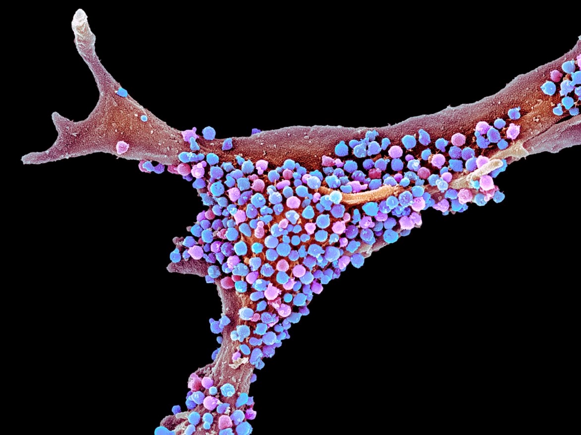 阿尔茨海默病与tau蛋白有关吗,淀粉样蛋白与阿尔茨海默病