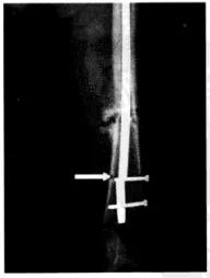 骨科髓内钉器械图谱,小儿骨科髓内钉取出术过程