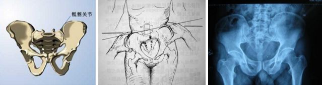 外国人正骨脊柱侧弯,脊柱侧弯正骨矫正手法