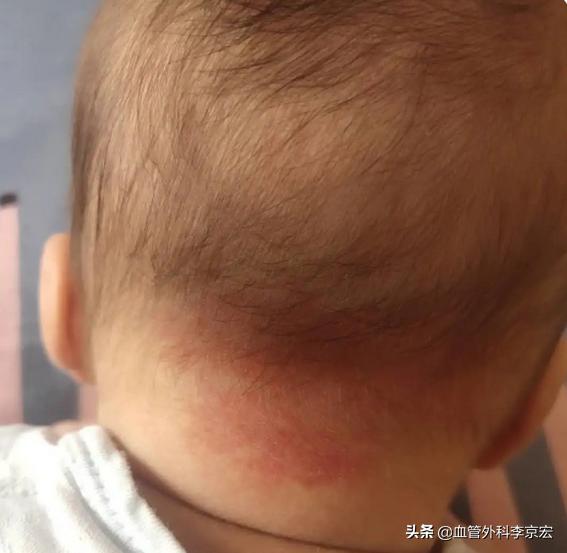 准妈有这些症状说明宝宝在长身体,宝宝身上有红斑是怎么回事