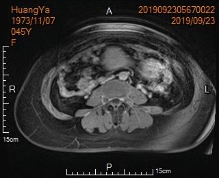 从手腕处做子宫动脉栓塞手术,子宫肌瘤做动脉穿刺有危险吗