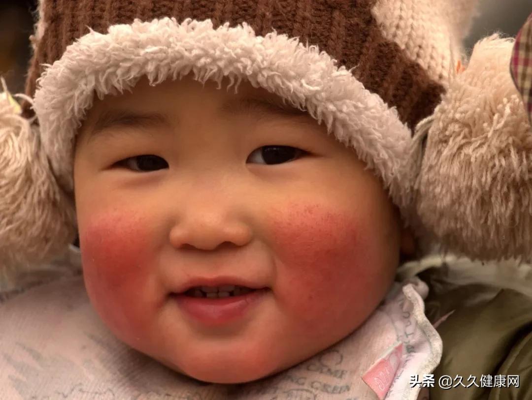 宝宝红脸蛋是食火吗,宝宝红脸蛋是因为角质层受损了吗