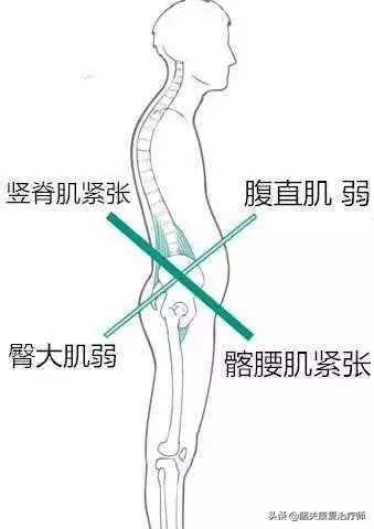 什么是下交叉综合征？下交叉综合症的解剖分析与纠正训练