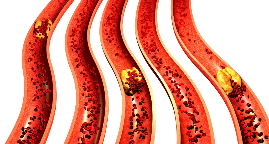 冠心病血管堵塞90%是什么症状,高龄老人心血管堵塞是什么症状