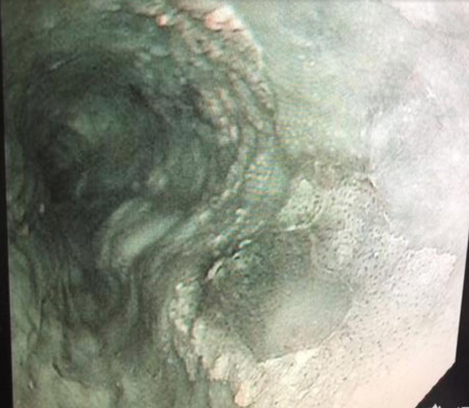 食管癌早期做胃镜能查到吗,食管癌通过胃镜可以检查出来吗