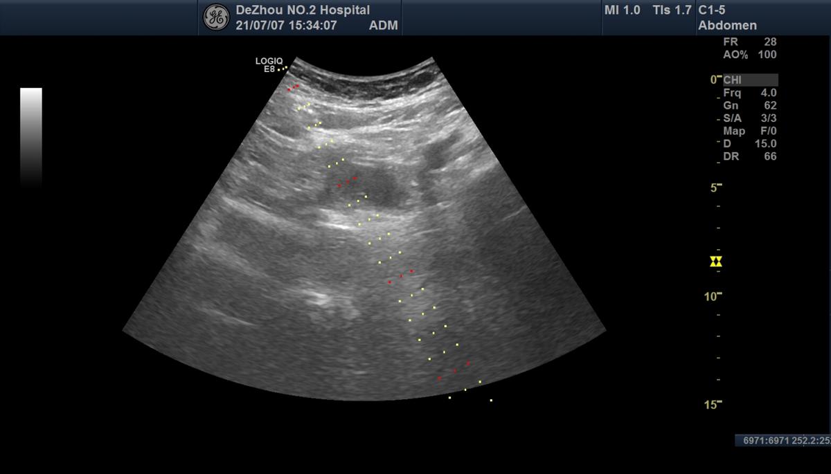 卵巢畸胎瘤和巧克力囊肿,未婚女性卵巢巧克力囊肿