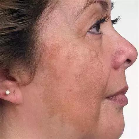 长出的斑怎么消除,长色斑怎么办5大方法祛除色斑