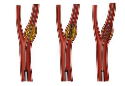 成年人脑梗继发癫痫最佳治疗方法,脑梗死癫痫部分发作