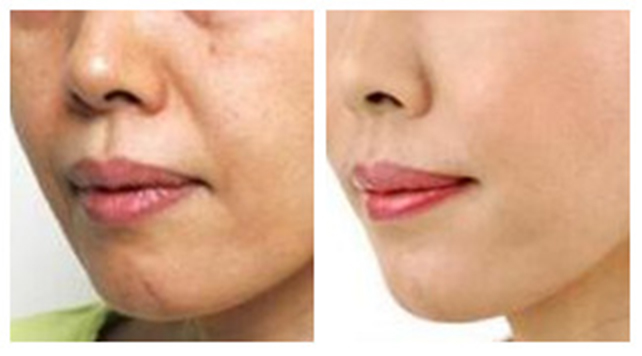 拉皮除皱手术真的有效吗,拉皮除皱手术真的有效果吗