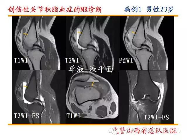 膝关节炎髌上囊积液自己看得出吗,髌上囊有积液膝盖会走路无力吗