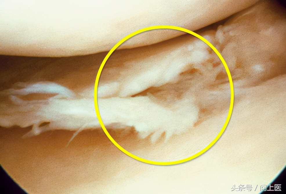 膝关节中度受损选择怎样的护膝,膝盖磨损要戴哪一种护膝好