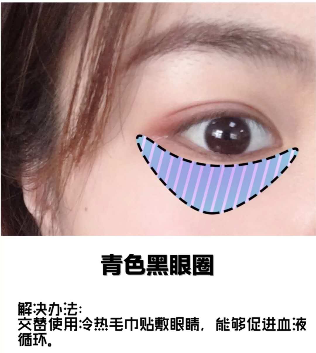 黑眼圈很重怎么办男士,黑眼圈很重怎么办中医教你