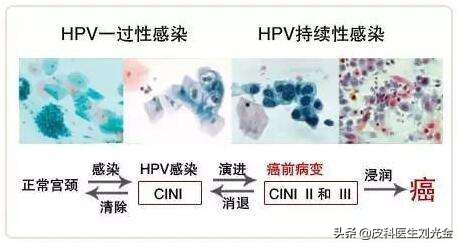 感染了HPV的体征,怎么样知道口腔咽喉感染了hpv