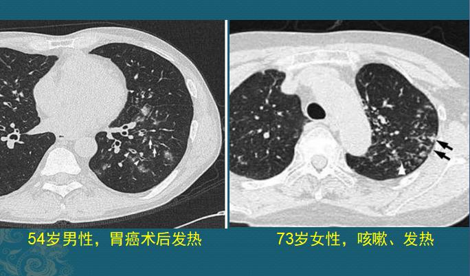 化脓性肺炎，硬扛3天不吃抗生素必后悔，这个细菌专治各种不服