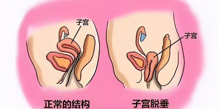 绝经期盆腔脏器脱垂怎么办,做盆腔脏器脱垂修复有用吗