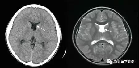 脑室为什么会扩张,脑室为什么会变小