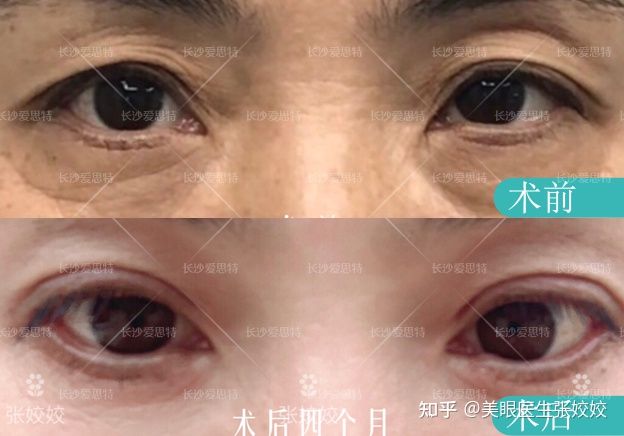 眼皮松弛双眼皮变成单眼皮怎么办,眼皮松弛割单眼皮全切双眼皮过程