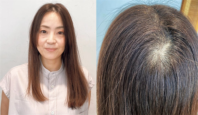 40岁女人头顶脱发严重怎么办,女人头顶有旋头发很少怎么处理