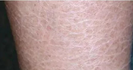 脚后跟干裂像鱼鳞是什么原因,脚后跟鱼鳞状干裂怎么刮