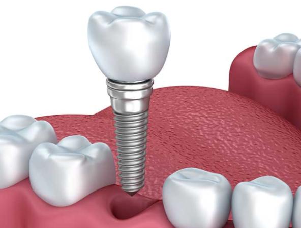 掉了三颗牙能做烤瓷牙吗,被牙医坑做烤瓷牙