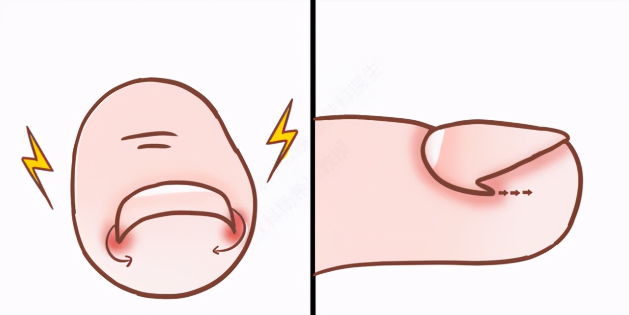 得了甲沟炎去哪里治得好,怎样治疗甲沟炎和脚趾痛