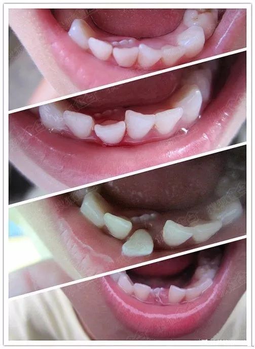 4岁儿童长出“双排牙”不得不一一拔掉！爸妈：只怪我们太宠溺