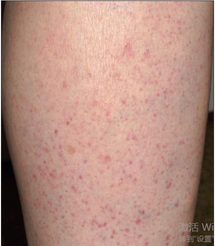 干燥综合症最怕的三种食物,干燥综合症的8大临床特征