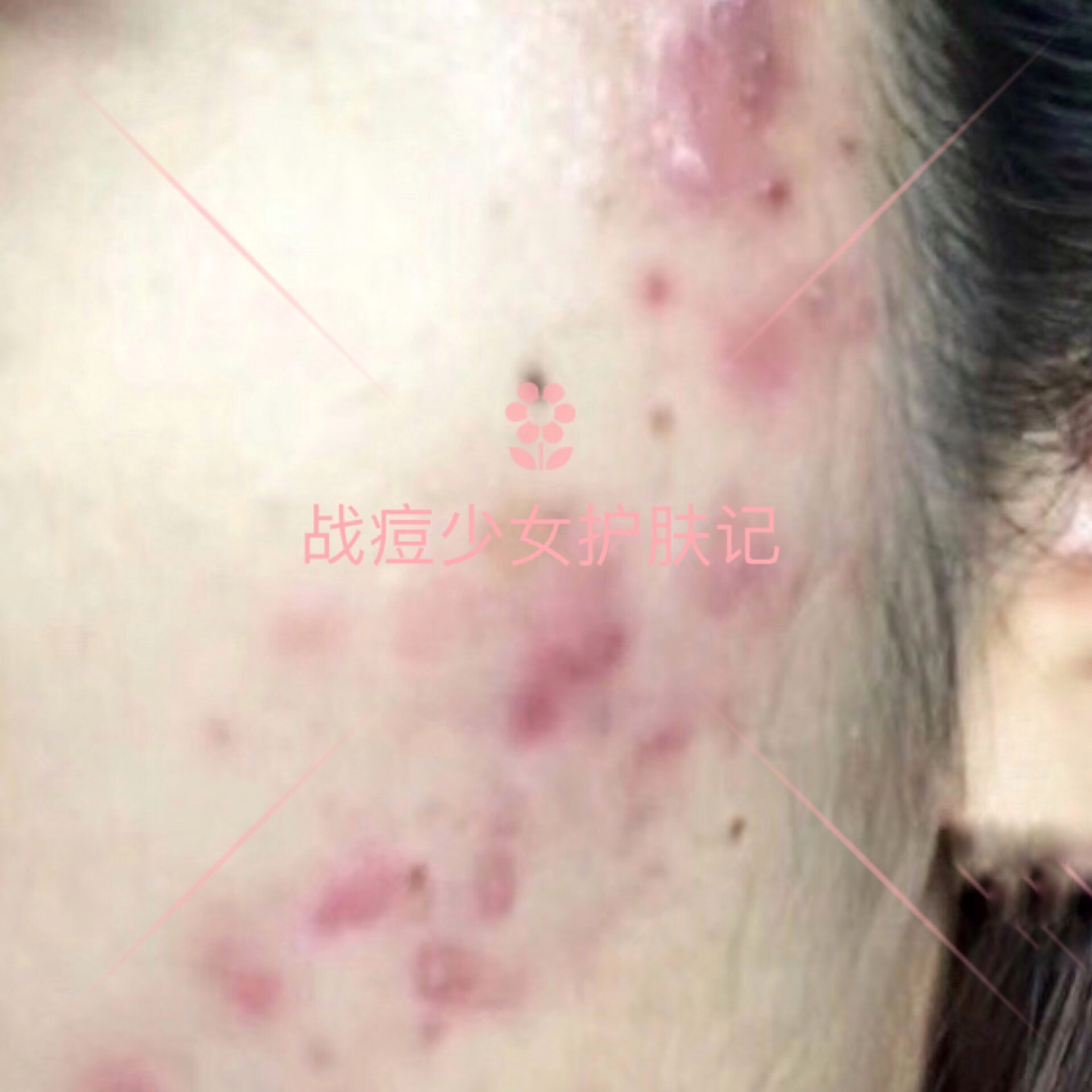 各种类型的痘痘怎么祛痘,痘痘六种类型上集