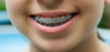 牙齿矫正照片拍摄视频,一分钟揭秘什么是牙齿矫正