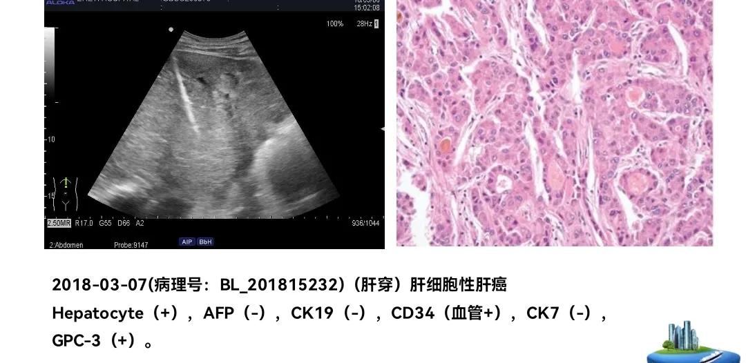 肝癌晚期靶向治疗怎么做,中国肝癌tace治疗展望
