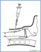 干货：气管切开术及护理措施