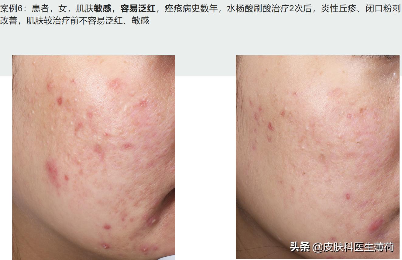 水杨酸精华果酸去闭口粉刺,刷酸去黑头收缩毛孔用哪个产品好