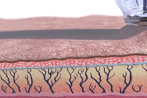 痘印根本治不住怎么办,痘印反反复复消不掉