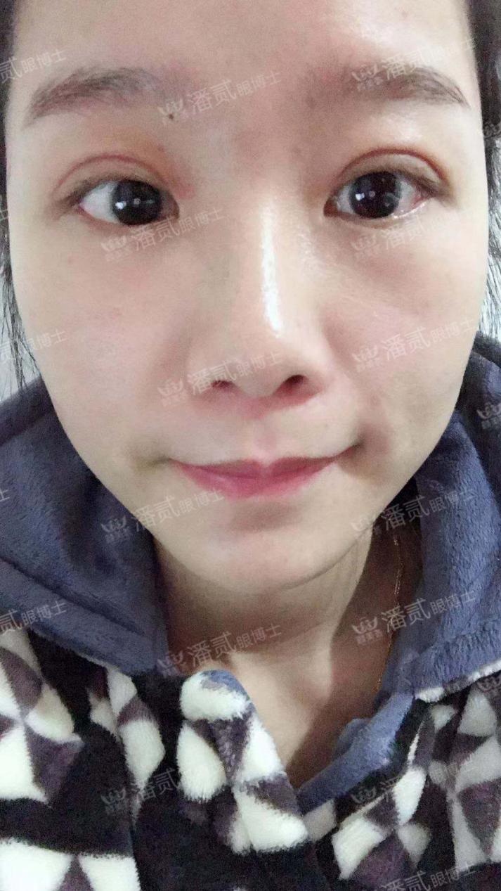 双眼皮整容失败眼皮跳动,双眼皮整形失败修复还花钱吗