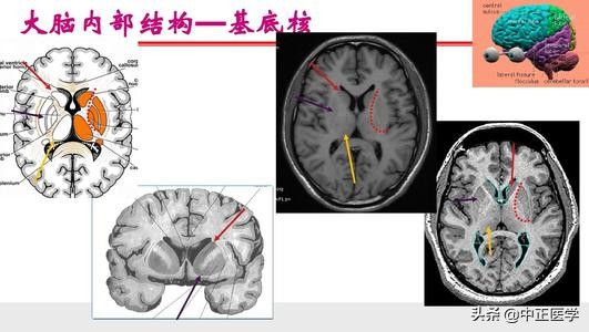 脑梗是不是能引起帕金森病呢,脑梗塞会引起脑出血吗怎么治